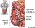 /album/fotogaleria/e-inflamatoria-intestinal-jpg/